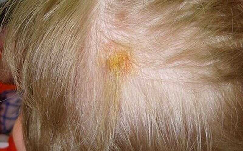 Причины бактериальной инфекции кожи головы
