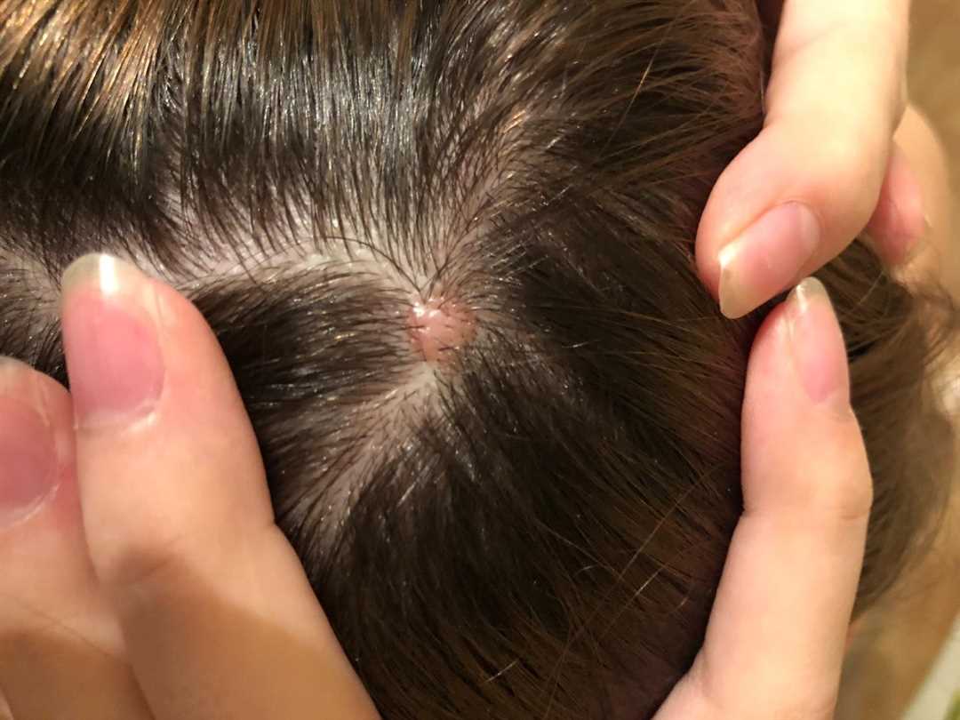 Бактериальная инфекция кожи головы: симптомы, причины и лечение