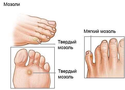 Бактериальная инфекция ног: причины, симптомы, лечение