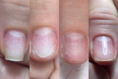 Бактериальная инфекция ногтя — как распознать, что она у вас есть и как ее излечить самостоятельно — основные симптомы, причины и наиболее эффективные методы лечения!