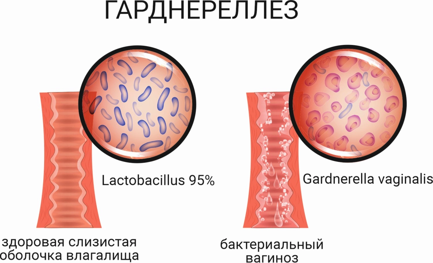 Причины возникновения бактериальной инфекции спермы