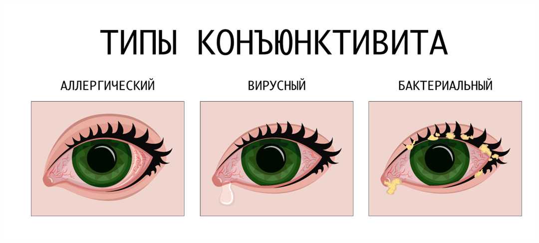 1. Красные глаза и отек конъюнктивы