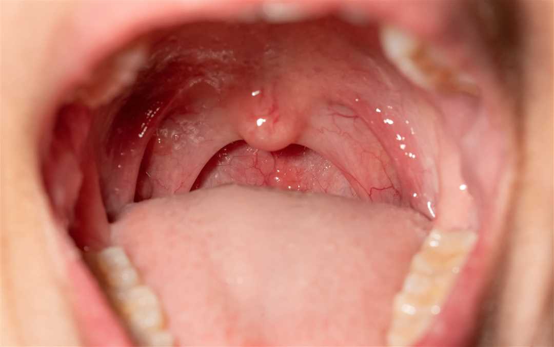 Бактериальная инфекция в горле у детей — признаки, лечение и профилактика важного заболевания
