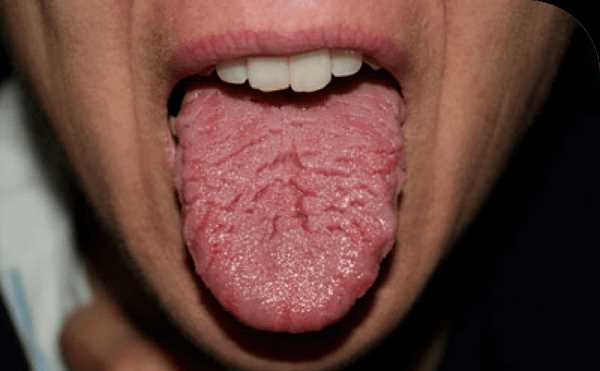 Редкие причины бактериальной инфекции языка