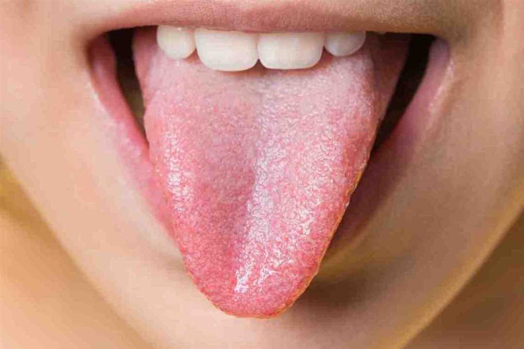 Симптомы бактериальной инфекции языка