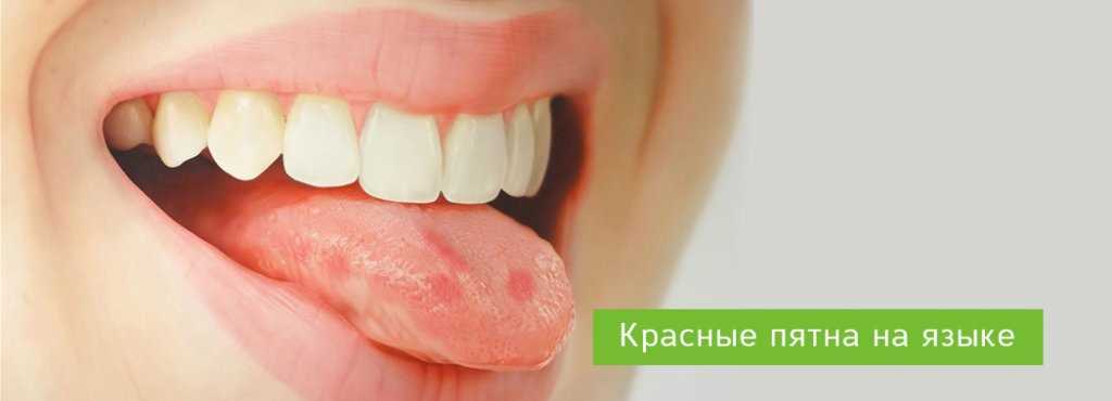 Бактериальная инфекция языка: симптомы, причины и лечение