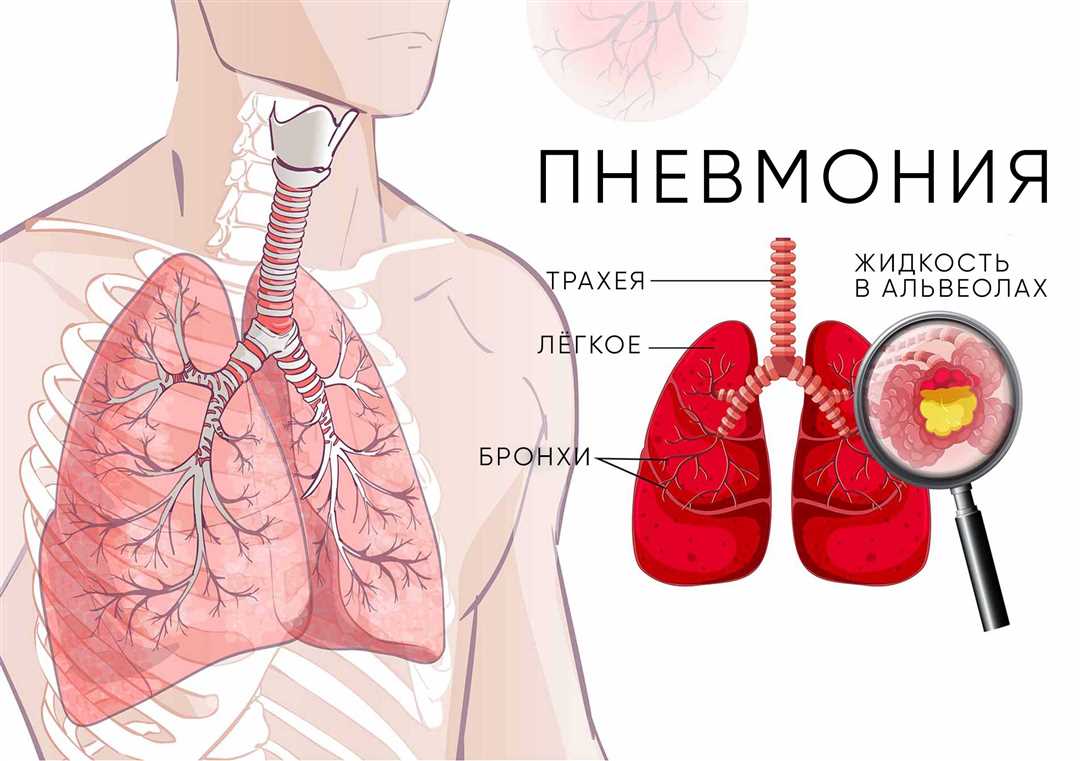 Бактериальная пневмония: причины, симптомы и лечение
