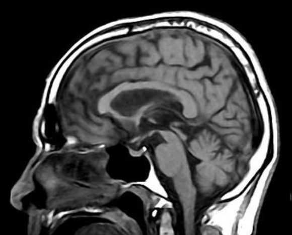 Перспективы использования МРТ в диагностике нейродегенеративных заболеваний