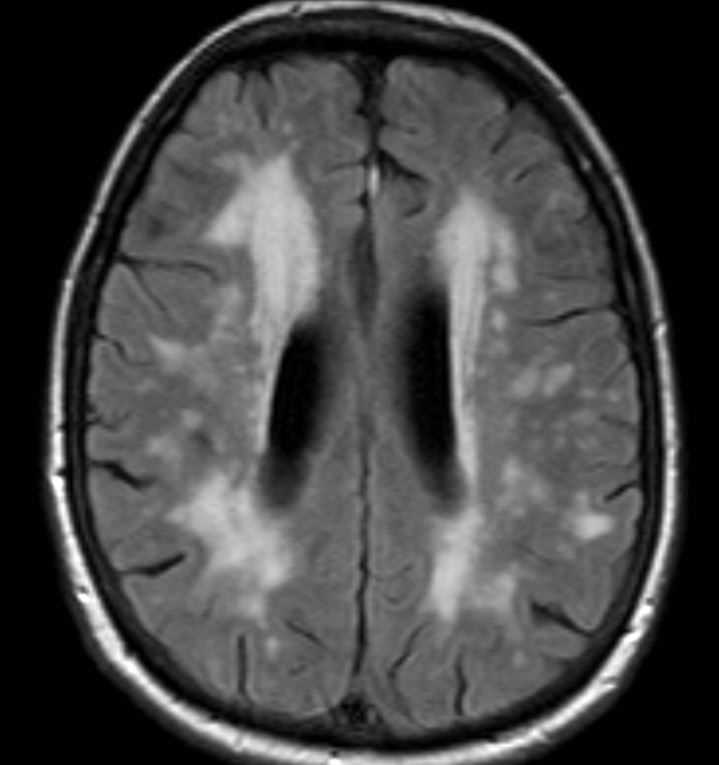 Роль МРТ в диагностике нейродегенеративных заболеваний
