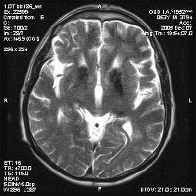 Диагностика нейродегенеративного заболевания головного мозга с помощью МРТ