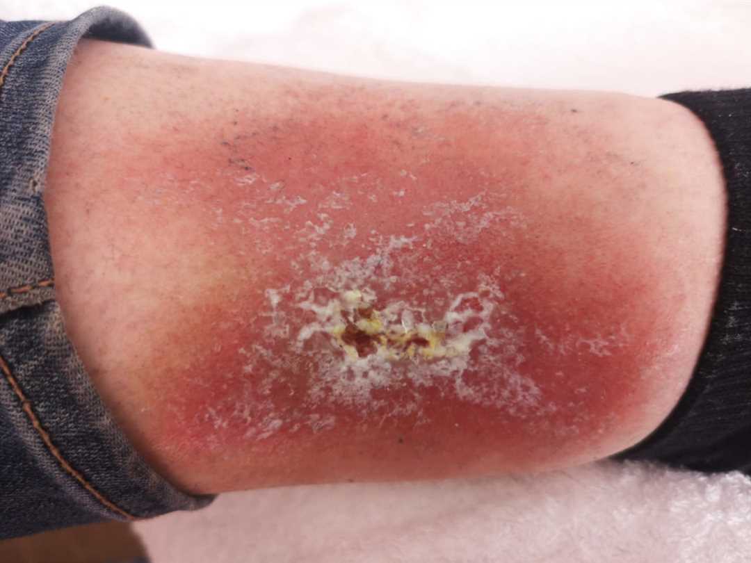 Как диагностировать грибковую инфекцию кожи?