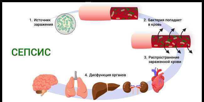 Инфекционные заболевания с проникновением патогенов в кровоток — клинические проявления, способы лечения и методы профилактики
