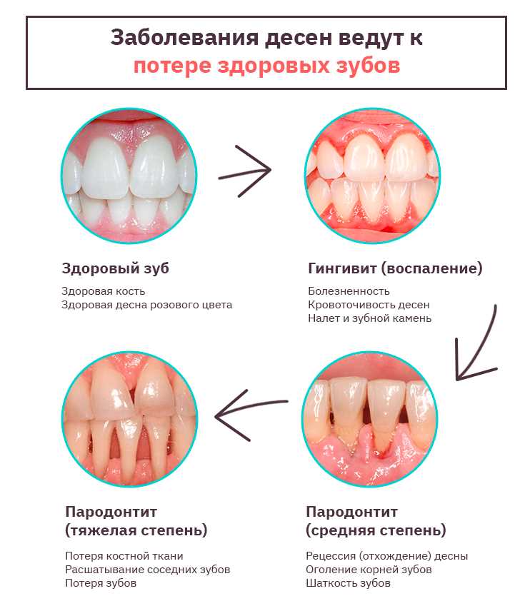 Что делать при боли зуба при периодонтите?