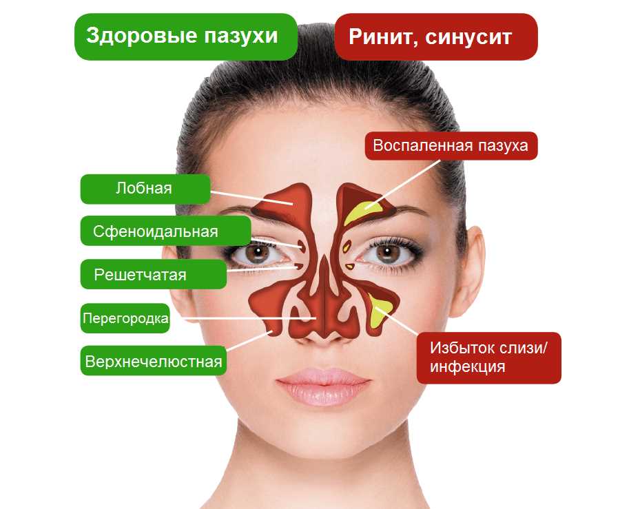 Как определить наличие бактериальной инфекции в носу: симптомы и диагностика