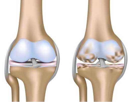 Диагностика и патогенез воспаления мягких тканей коленного сустава