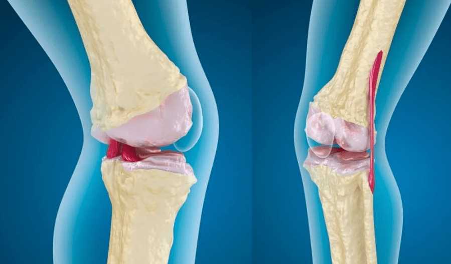 Лечение воспаления мягких тканей коленного сустава: методы и рекомендации