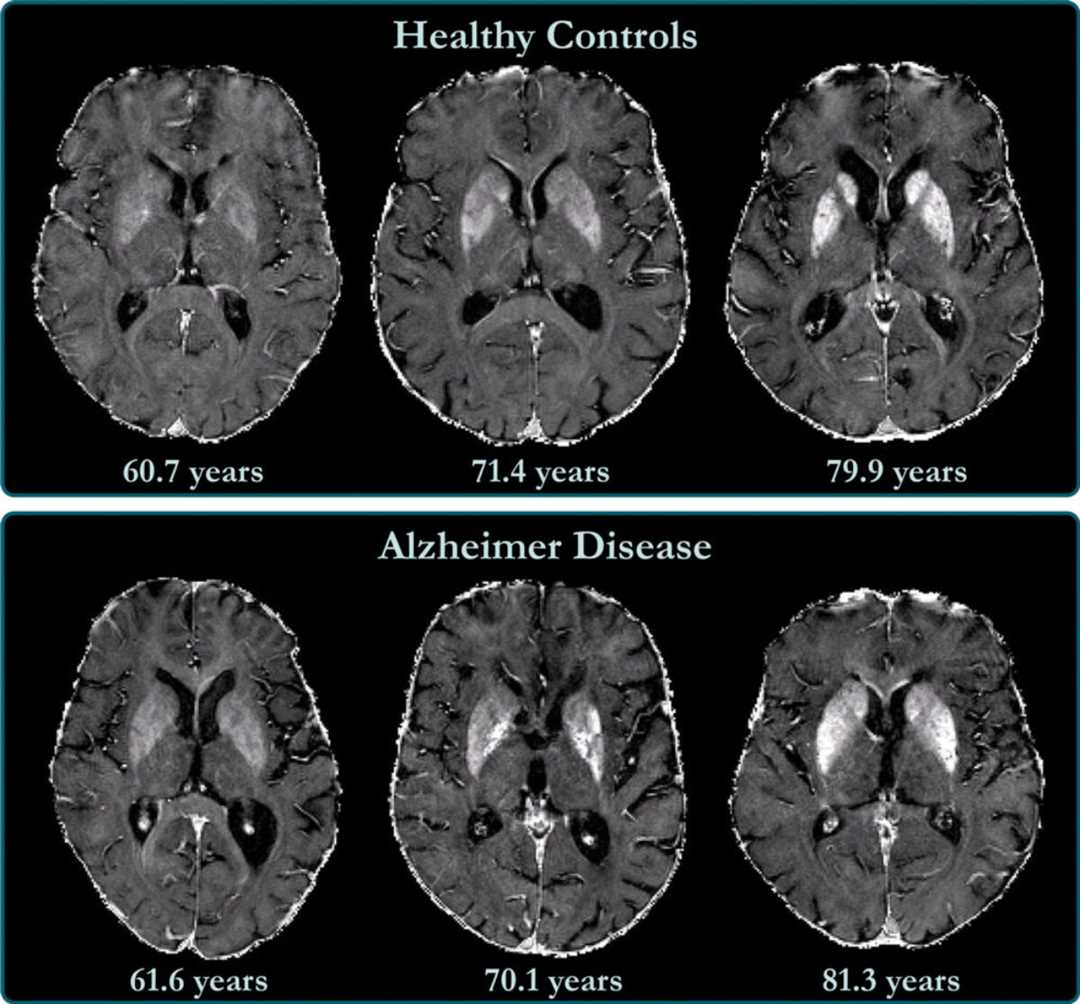  Рекомендации для профилактики болезни Альцгеймера 