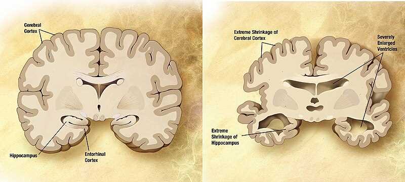 Нейродегенеративные заболевания: как развивается болезнь Альцгеймера?