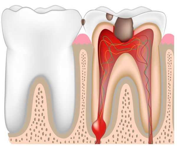Патологическая анатомия воспалительного процесса в пульпе зуба: причины и симптомы