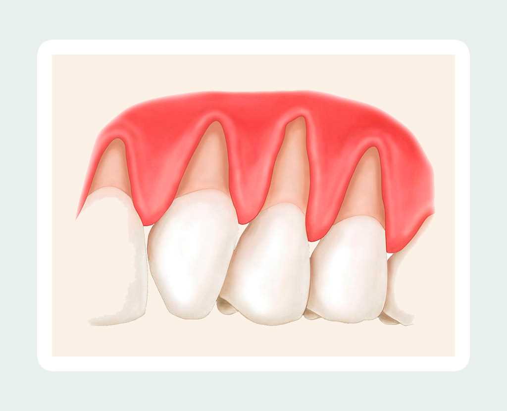 Патологические гетерогенные процессы на поверхности зубной эмали: причины, симптомы, методы лечения