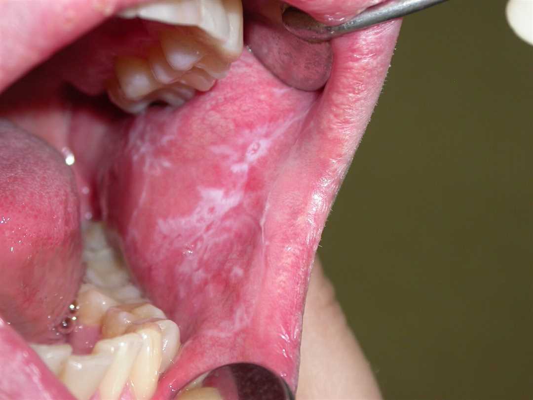 Патологические процессы в полости рта: причины, симптомы и лечение