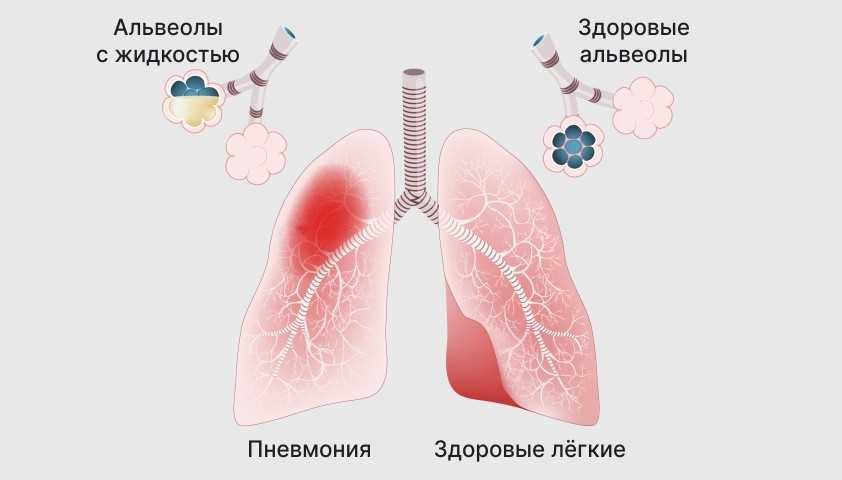Пневмония: бактериальная инфекция или вирусная? Сравнение и причины