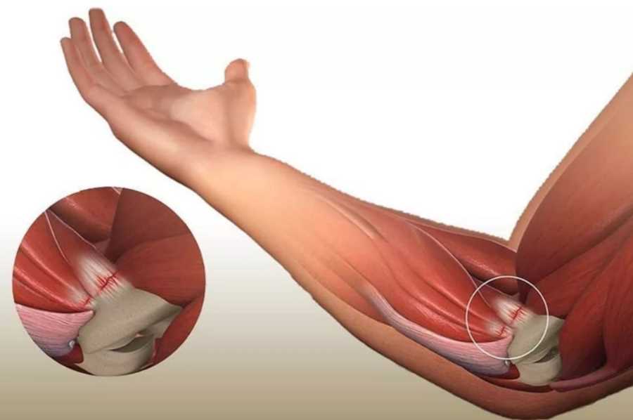 Повреждение мышц и соединительных тканей: основные причины и факторы