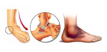 Повреждение мягких тканей голени: причины, симптомы и лечение