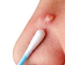 Повреждение мягких тканей носа: симптомы, лечение, реабилитация