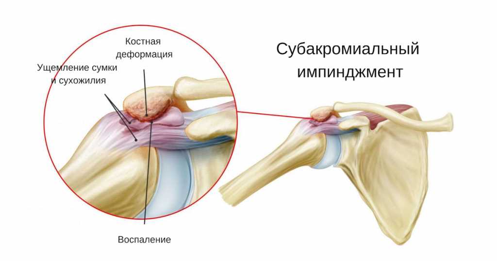 Повреждение мягких тканей плечевого сустава: причины, симптомы, лечение