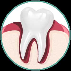 Лечение кариеса и гнилых зубов