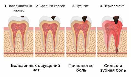 Повреждение мягких тканей зуба: причины, симптомы, лечение