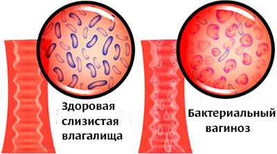 Последствия вторичной бактериальной инфекции для пациентов с COVID-19
