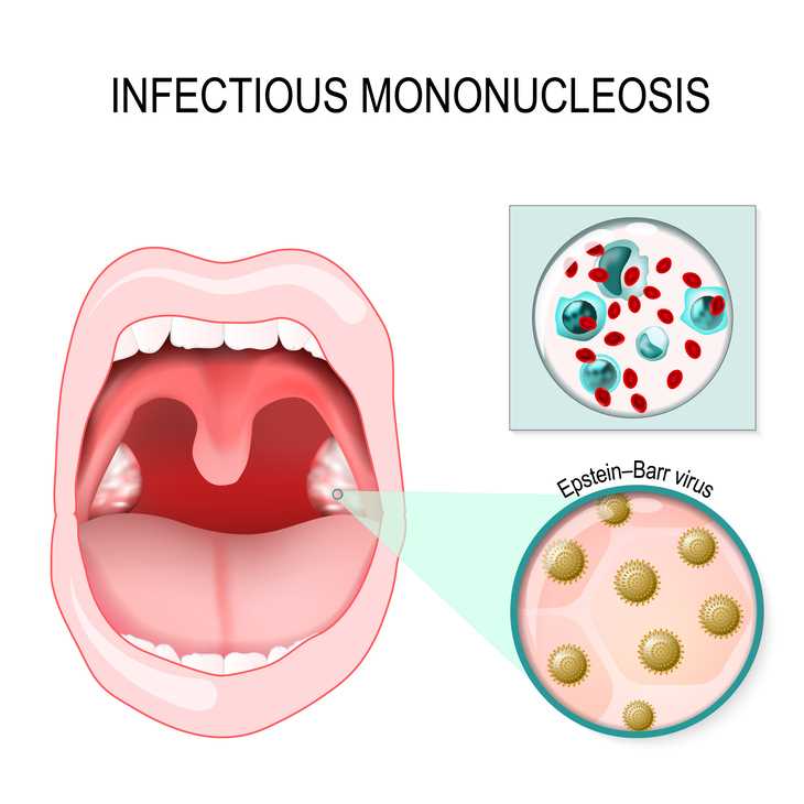 Причины и последствия присоединения вторичной бактериальной инфекции