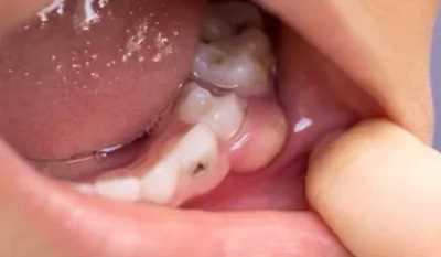 Методы лечения зубной инфекции