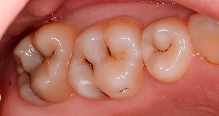 Симптомы и лечение бактериальной инфекции зубов. Все о зубной инфекции