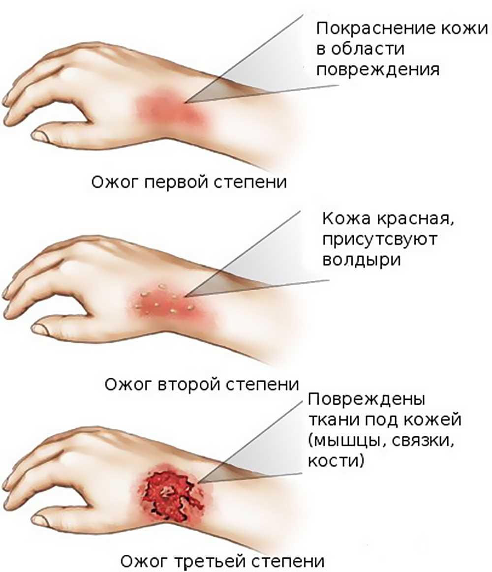 Специфика тканевых повреждений при обширных травмах