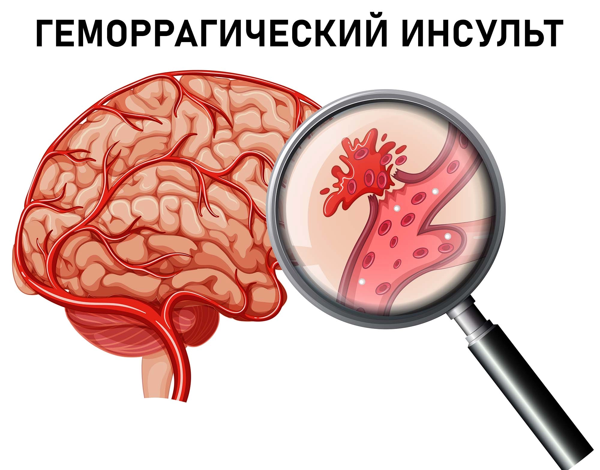 Профилактика воспаления головного мозга: как избежать заболевания
