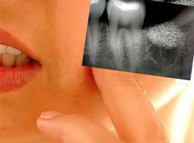 Осложнение после удаления зуба - альвеолит