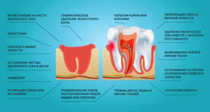 Воспаление костной ткани после удаления зуба: причины и способы лечения