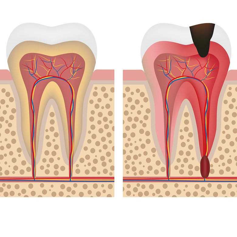 Как лечить воспаление костной ткани зубов?