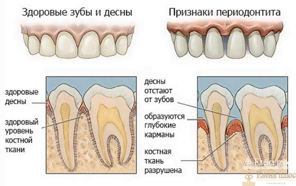 Основные причины развития воспаления костной ткани зубов