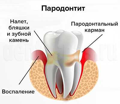 Профилактика воспаления костной ткани зубов: как избежать проблем