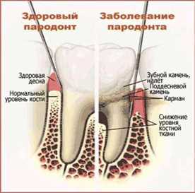 Эффективные методы лечения воспаления костной ткани зубов