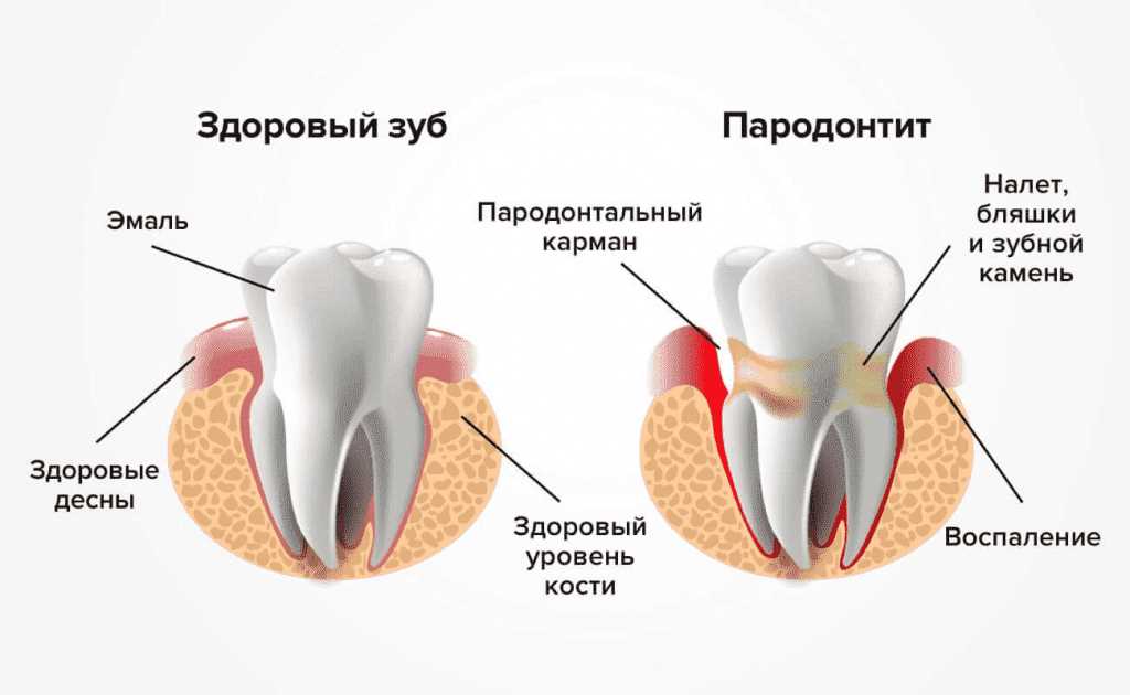 Воспаление костной ткани зубов: причины, симптомы, лечение и профилактика