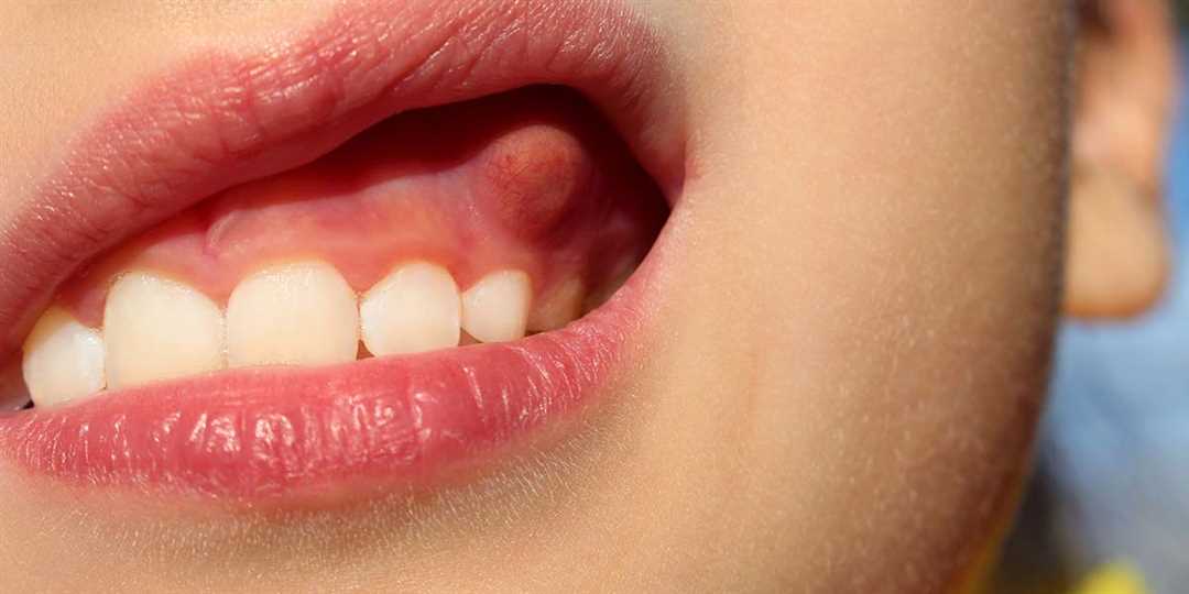 Регулярная гигиена полости рта