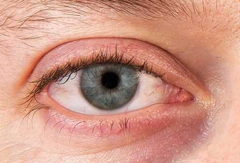 Общие признаки воспаления мягких тканей глаза