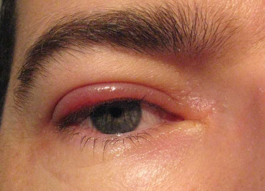Воспаление мягких тканей глаза — причины, симптомы и эффективные методы лечения
