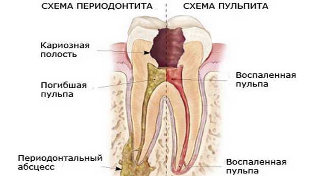 Воспаление периапикальных тканей зуба: причины, симптомы, лечение