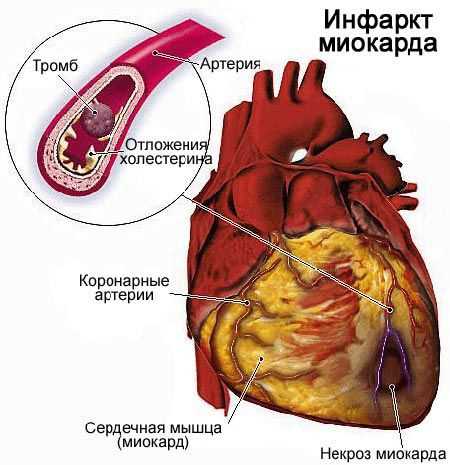 Воспаление тканей сердца: симптомы, причины и лечение